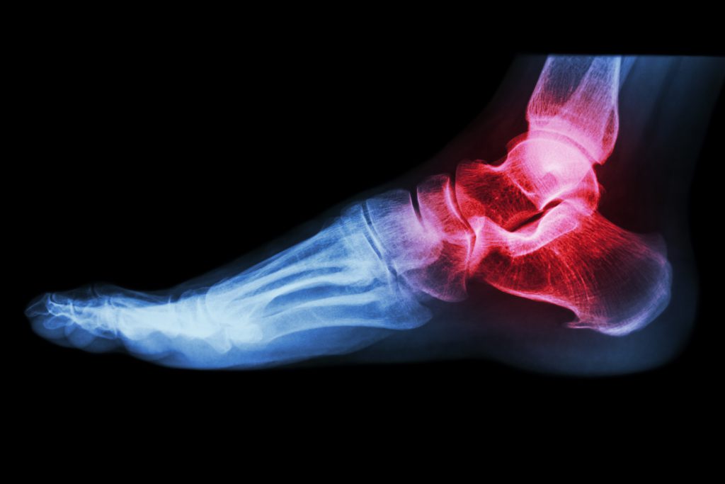 Ankle Joint Arthritis - Podiatry Clinics (Yorkshire) Ltd