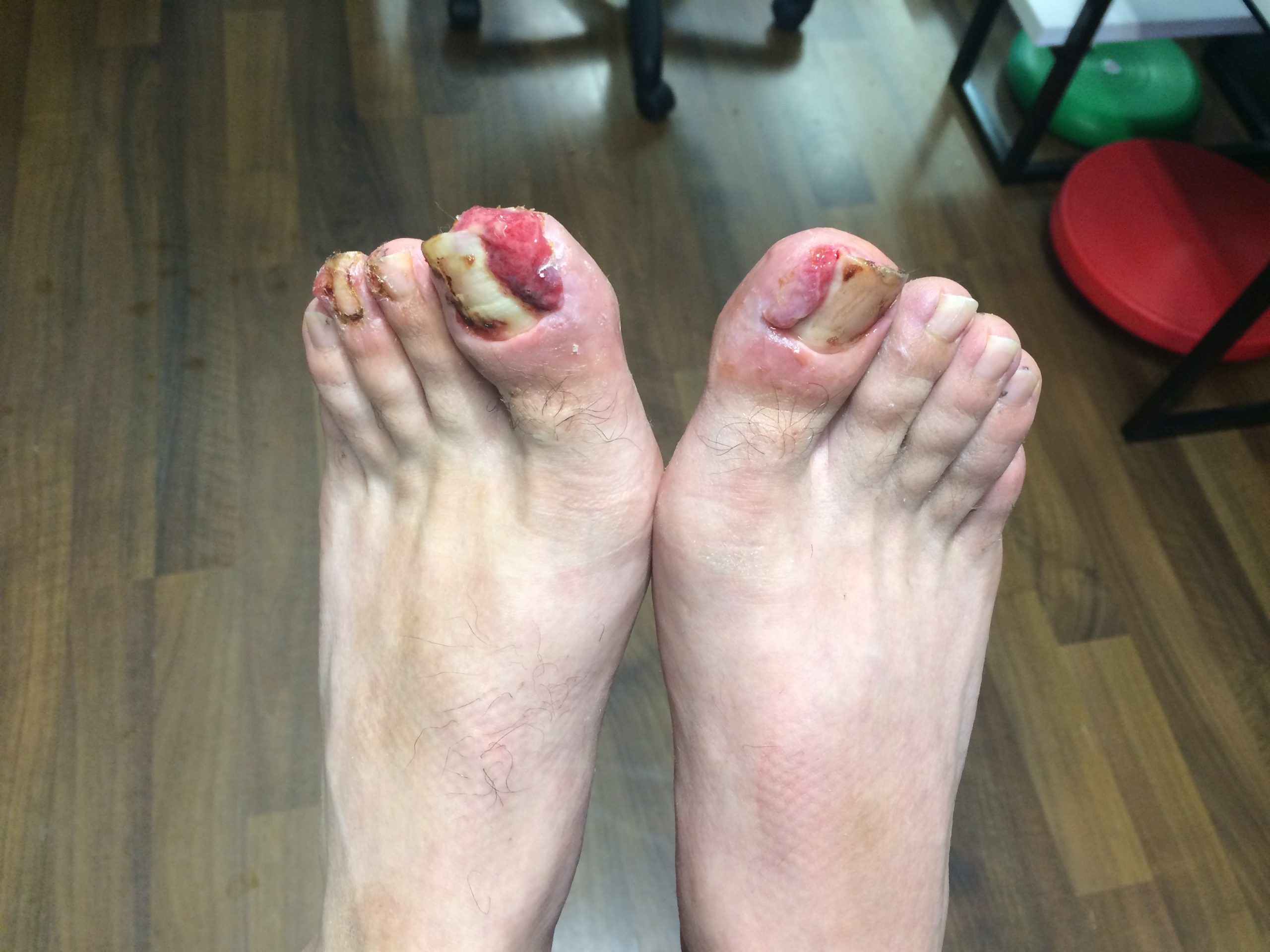 Ingrown toenail surgery in Leeds, York, Wetherby and Wharfedale