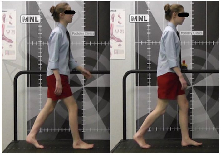 Published research with Andy Horwood — a case study on Freiberg’s infraction
